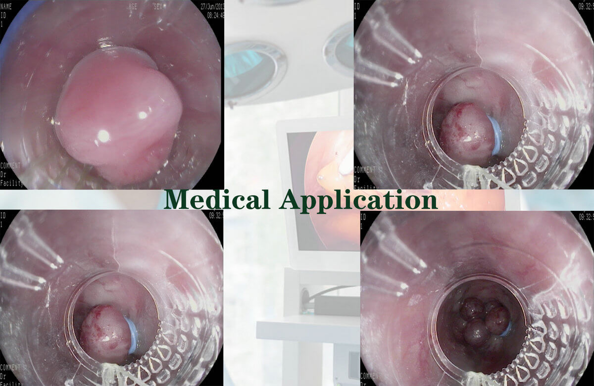 7 Band Endoscopic Multi Band Ligator For Esophageal Varices (7)